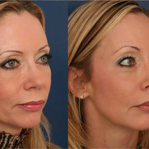 Facial Filler